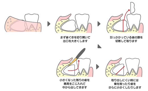 親知らずの抜歯