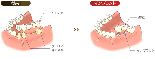 両隣に歯が残っている場合