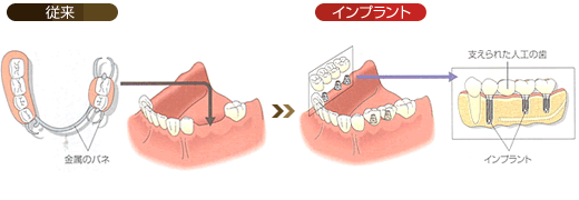 両隣に歯が残っていない場合