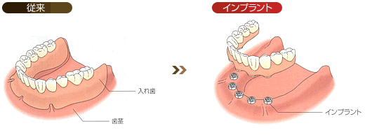 1本も歯がない場合