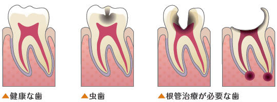 根管治療とは