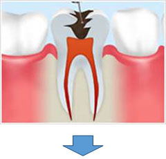 根管治療の流れ