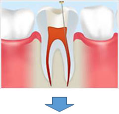 根管治療の流れ