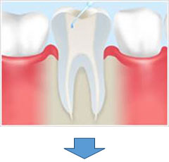 根管治療の流れ