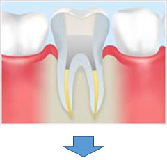 根管治療の流れ