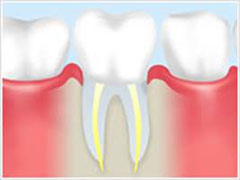 根管治療の流れ