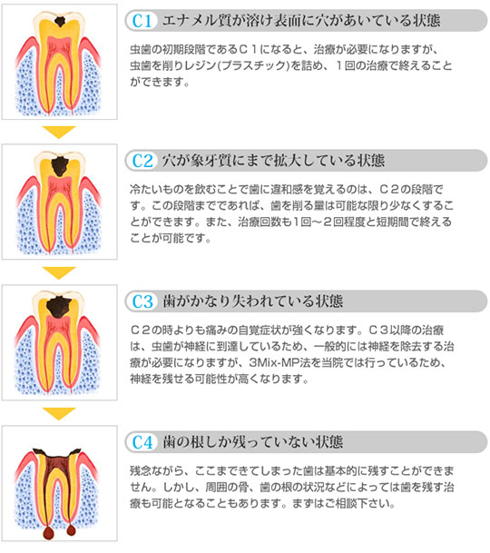 虫歯の進行