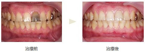 セラミック治療