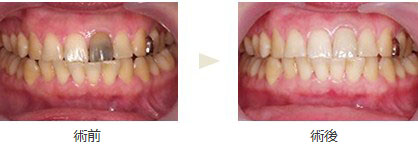 ハイブリッドセラミック治療