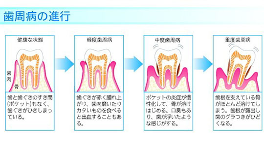 歯周病の進行