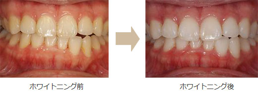 ホワイトニング症例