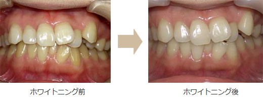 ホワイトニング症例