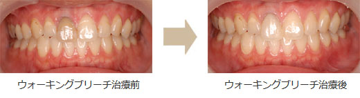 ホワイトニング症例